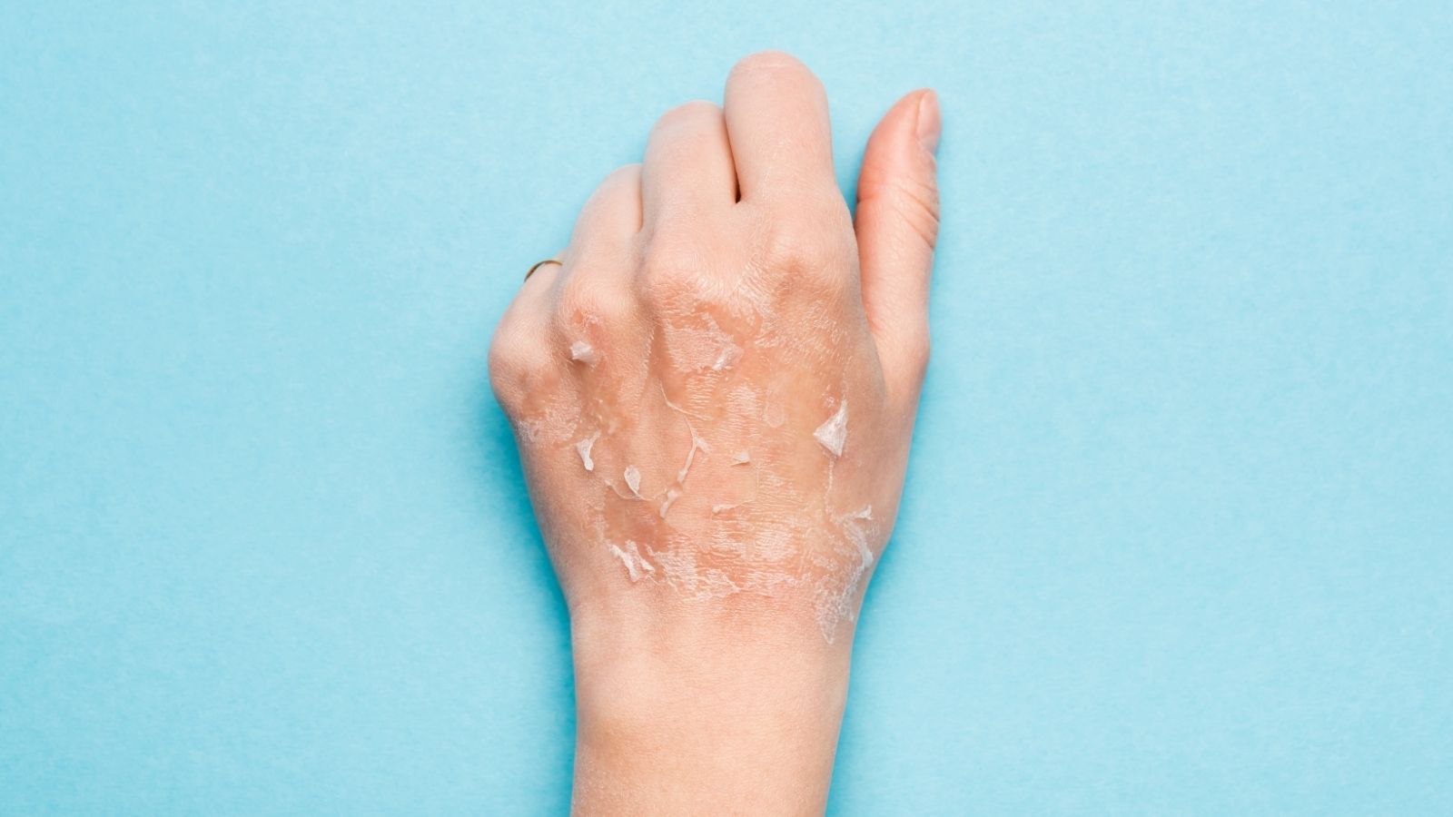 A hand with flaky, peeling skin on the back appears against a light blue background.